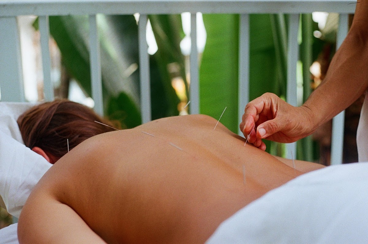Acupuncture By Mia