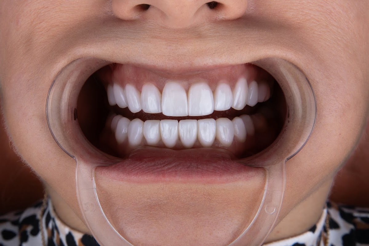 Smile Design Miami
